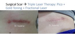 ดูแลรอยแผลผ่าตัด Surgical Scar เพื่อป้องกันการเกิดแผลเป็นนูนเกิน Hyperthrophic Scar และคีลอยด์ Keloid