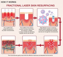 ดูแลหลุมสิวลึกด้วยเทคนิค Multi Direction Deep Focused Ablative Laser