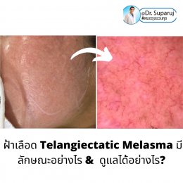 ฝ้าเลือด Telangiectatic Melasma มีลักษณะอย่างไร & ดูแลได้อย่างไร?