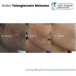 ฝ้าเลือด Telangiectatic Melasma มีลักษณะอย่างไร & ดูแลได้อย่างไร?