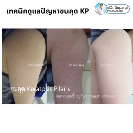 เทคนิคดูแลปัญหาขนคุด KP Keratosis Pilaris Treatment ขนคุด (Keratosis Pilaris) หรือเรียนอีกชื่อว่า “ผิวหนังไก่”