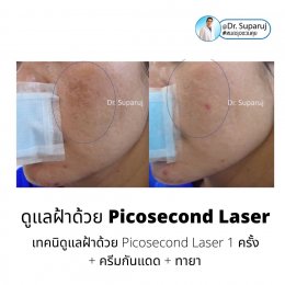 Update เทคนิครักษาฝ้า Melasma Treatment