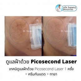 Update เทคนิครักษาฝ้า Melasma Treatment