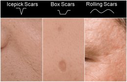 การรักษารอยแผลเป็นแบบหลุมจากสิว Atrophic Acne Scar ด้วยการผ่าตัด Scar Revision คืออะไร ?