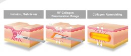 ดูแลหลุมสิวด้วยเทคนิคศัลยกรรมหลุมสิว Acne Scar Revision Surgery คืออะไร