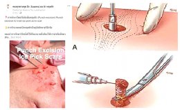 รักษาหลุมสิวด้วยการผ่าตัด Acne Scar Revision ด้วยเทคนิคผ่าตัดออก Punch Excision