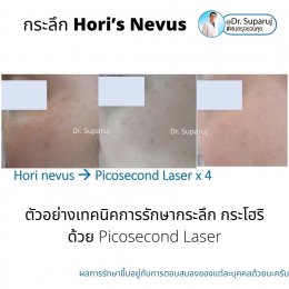 กระลึก หรือปานโฮริ หรือ กระโฮริ (Hori's nevus) มีลักษณะอย่างไร รักษาได้อย่างไร?