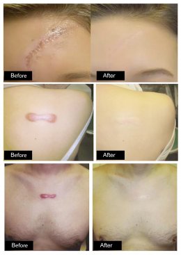 ดูแลแผลเป็นนูน คีลอยด์ ด้วยเทคนิค Triple Laser Therapy: Picosecond Laser + Gold Toning + Fractional Laser + ฉีดยา Intralesional Injection