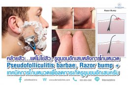 คล้ายสิว…แต่ไม่ใช่สิว: รูขุมขนอักเสบหลังการโกนหนวด Pseudofolliculitis barbae, Razor bump +เทคนิคการโกนหนวดเพื่อลดการเกิดรูขุมขนอักเสบครับ