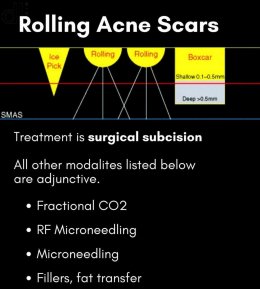 Rolling Acne Scars รอยแผลเป็นหลุมจากสิวที่มีลักษณะกว้าง และตื้น คล้ายกระทะ ก้นแผลจะดูไม่เรียบ เกิดจากสิวอักเสบขนาดใหญ่ที่เกิดการยุบตัวลงของผิว รอยยุบเป็นแอ่งกว้างคล้ายกระทะ