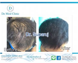 “De Med Hair & Scalp Care Treatment” ทรีทเมนท์ผมและหนังศีรษะสูตรพิเศษโดย De Med Clinic 