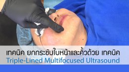เทคนิค ยกกระชับใบหน้าและคิ้วด้วย เทคนิค Triple-Lined Multifocused Ultrasound