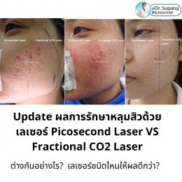 Update ผลการรักษาหลุมสิวด้วยเลเซอร์ Picosecond Laser VS Fractional CO2 Laser ต่างกันอย่างไร? เลเซอร์ชนิดไหนให้ผลดีกว่า?