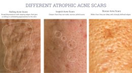 Update เทคนิค Subcision ตัดพังผืดรักษาหลุมสิว Acne Scar Subcision Techniques