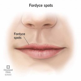  Fordyce Spot ตุ่มไขมันที่ริมฝีปาก คืออะไร มีลักษณะอย่างไร & มีวิธีดูแลได้อย่างไรบ้าง?