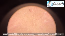 แผลเป็นจากสิวที่มีลักษณะสีขาว severe fibrotic acne scar เกิดจากอะไร & ดูแลได้อย่างไร ?