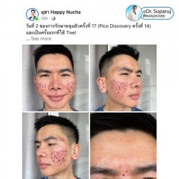 "แนะนำเทคนิคดูแลผิวหลังรักษาหลุมสิวด้วยเลเซอร์ครับIntroducing Techniques for Caring for and Treating Acne Scars with Laser"