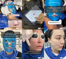 ขอบคุณคุณจูน @jirasuri มากนะครับที่ไว้วางใจให้หมอได้ดูแลปัญหาเรื่องรูขุมขนและจุดด่างดำด้วย โปรแกรม LaserME ครับผม