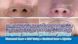 แนะนำเทคนิคดูแลแผลเป็นจากการผ่าตัด: ดูแลแผลเป็นนูนจากการผ่าตัดปีกจมูก Alarplasty ด้วยเทคนิค MultiLaser Therapy: Picosecond Laser + Gold Toning + Fractional Laser + Injection