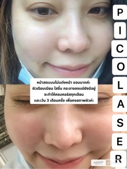 แนะนำเทคนิคดูแลรูขุมขนกว้าง: เทคนิคดูแลรูขุมขนกว้างด้วย Deep Carbon Peel Picosecond Laser (เทคนิคการใช้ Picosecond Laser พิโค่เลเซอร์ ร่วมกับผง carbon กระตุ้นการสร้างคอลลาเจนดูแลรูขุมขนกว้าง )