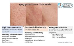 รูขุมขนกว้าง Enlarged Facial Pore เกิดจากอะไร ? + เทคนิคดูแลด้วยโปรแกรม Discovery Pico Laser หลายความยาวคลื่น +หลายพลังงานร่วมกัน