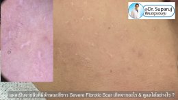 แผลเป็นจากสิวที่มีลักษณะสีขาว severe fibrotic acne scar เกิดจากอะไร & ดูแลได้อย่างไร ?