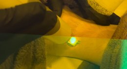 เทคนิคดูแลปานแต่กำเนิดด้วยเลเซอร์ดิสคัฟเวอรี่พิโค Birthmark Treatment with Special Handpieces of Discovery Pico Laser