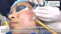 Update ผลการรักษาหลุมสิวด้วยเทคนิค Rejuran Healer อย่างเดียว vs Rejuran + Picosecond Laser vs Picosecond Laser อย่างเดียว แตกต่างกันอย่างไร เทคนิคไหนให้ผลดีที่สุด ? 