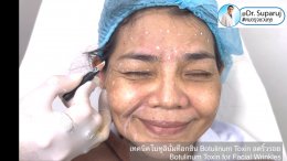 เทคนิคโบทูลินั่มท็อกซิน Botulinum Toxin ลดริ้วรอย Botulinum Toxin for Facial Wrinkles