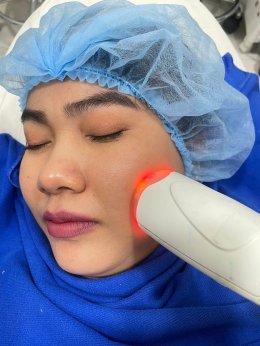 โปรแกรม PORA COOL + Skin Radiant Treatment โพล่าร์คูล + สกินเรเดียน ทรีทเมนท์ หน้ากระจ่างใส ลดการอักเสบของผิว ลดสิว