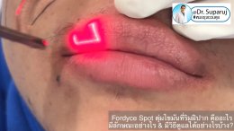  Fordyce Spot ตุ่มไขมันที่ริมฝีปาก คืออะไร มีลักษณะอย่างไร & มีวิธีดูแลได้อย่างไรบ้าง?