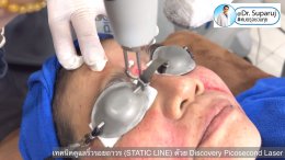 เทคนิคดูแลริ้วรอยถาวร (STATIC LINE) ด้วย Discovery Picosecond Laser