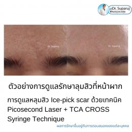  แนะนำเทคนิครักษาหลุมสิวจิกลึก Ice Pick Acne Scar ด้วยเทคนิคเลเซอร์ UltraDeep Pico Technique (Ice Pick Acne Scar Treatment with Discovery Pico Laser + UltraDeep Pico Technique)