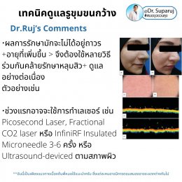 แนะนำเทคนิคดูแลรูขุมขนกว้าง: ตัวอย่างผลการดูแลรูขุมขนกว้าง Enlarged Facial Pore ด้วย MultiMode Picosecond Laser