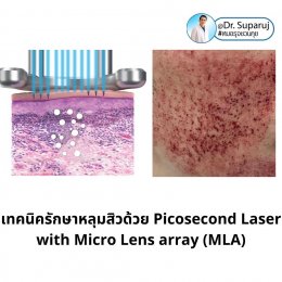 Update ผลการรักษาหลุมสิวด้วย Picosecond Laser VS InfiniRF Microneedle แตกต่างกันอย่างไร อันไหนมีประสิทธิภาพดีกว่า ?