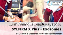 แนะนำเทคนิคดูแลแผลเป็นหลุมสิวด้วย SYLFIRM X Plus + Exosomes (SYLFIRM X Plus & Exosomes for Acne Scar Treatment)
