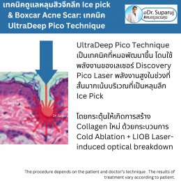  แนะนำเทคนิครักษาหลุมสิวจิกลึก Ice Pick Acne Scar ด้วยเทคนิคเลเซอร์ UltraDeep Pico Technique (Ice Pick Acne Scar Treatment with Discovery Pico Laser + UltraDeep Pico Technique)