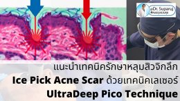  แนะนำเทคนิครักษาหลุมสิวจิกลึก Ice Pick Acne Scar ด้วยเทคนิคเลเซอร์ UltraDeep Pico Technique (Ice Pick Acne Scar Treatment with Discovery Pico Laser + UltraDeep Pico Technique)