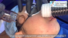 โปรแกรมเลเซอร์ Fractional CO2 Laser ยังใช้รักษาหลุมสิวได้อยู่ไหม ?