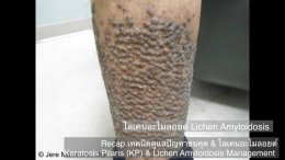  Recap เทคนิคดูแลปัญหาขนคุด & ไลเคนอะไมลอยด์ Keratosis Pilaris (KP) & Lichen Amyloidosis Management