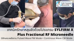 แนะนำเทคนิครักษาหลุมสิวด้วยโปรแกรม SYLFIRM X Plus Fractional RF Microneedle: มีลักษณะพลังงาน Pulsed Wave PW Mode + Continous Wave CW Mode