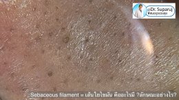 Sebaceous filament = เส้นใยไขมัน คืออะไรมี ?ลักษณะอย่างไร ? ดูแลได้อย่างไร? 