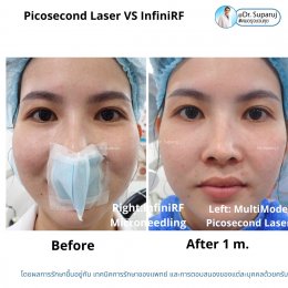 แนะนำเทคนิครักษาหลุมสิว: ดูแลหลุมสิวด้วยเข็มพลังงานคลื่นวิทยุ Infini RF Microneedle