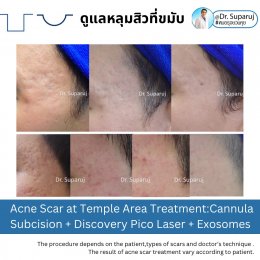 Update รักษาหลุมสิวด้วยเทคนิคการตัดพังผืด Blunt Blade Subcision (Blunt Blade Subcision for Acne Scar Fibrosis Treatment)