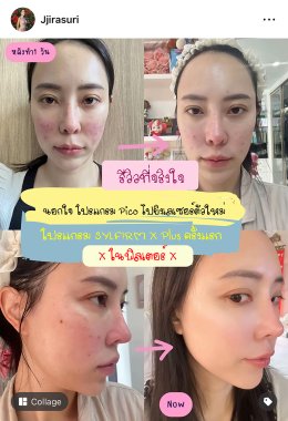 นอกใจโปรแกรมเลเซอร์ Pico ลองของใหม่ โปรแกรม SylfirmXplus