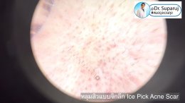 Back to the Basics: หลุมสิวมีกี่ชนิด & มีลักษณะอย่างไร ? Acne Scar Classification Full Clip คลิปเต็ม Facebook/ YouTube Dr. Suparuj หมอรุจชวนคุย ครับ