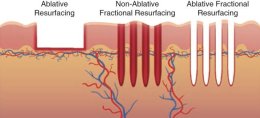 โปรแกรมเลเซอร์ Fractional CO2 Laser ยังใช้รักษาหลุมสิวได้อยู่ไหม ?