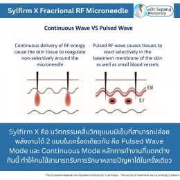 Update เทคนิคยกกระชับผิว หลุมสิว ดูแลปัญหาเม็ดสี ฝ้า+เส้นเลือด ด้วยนวัตกรรมคลื่นวิทยุแบบเข็ม Fractional microneedle Radiofrequency : SYLFIRM X