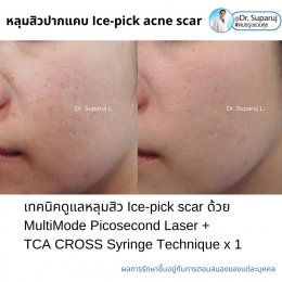  แนะนำเทคนิครักษาหลุมสิวจิกลึก Ice Pick Acne Scar ด้วยเทคนิคเลเซอร์ UltraDeep Pico Technique (Ice Pick Acne Scar Treatment with Discovery Pico Laser + UltraDeep Pico Technique)