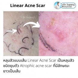  เทคนิคประเมินความรุนแรงพังผืดหลุมสิว Acne Scar Fibrosis Assessment : เทคนิคดึงยืดผิว Mannual Strechching (ง่ายๆ ประเมินได้ด้วยตัวเองครับ )